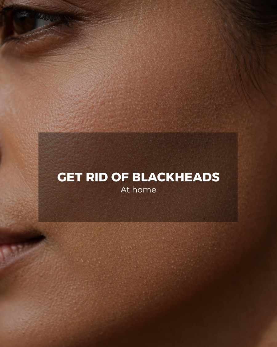Close-up of facial skin with blackheads – how to get rid of blackheads at home with Frosteam