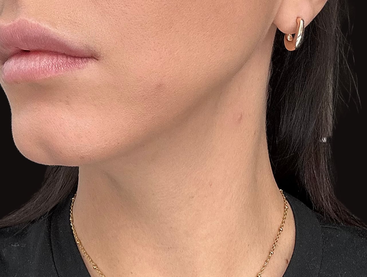 Before Frosteam treatment showing visible skin texture, uneven tone, and mild puffiness along the jawline and neck area