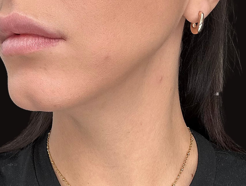Before Frosteam treatment showing visible skin texture, uneven tone, and mild puffiness along the jawline and neck area