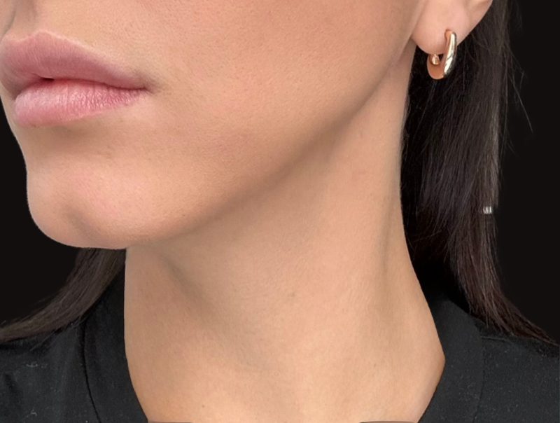 Smooth, depuffed jawline and neck after a Frosteam cold therapy session