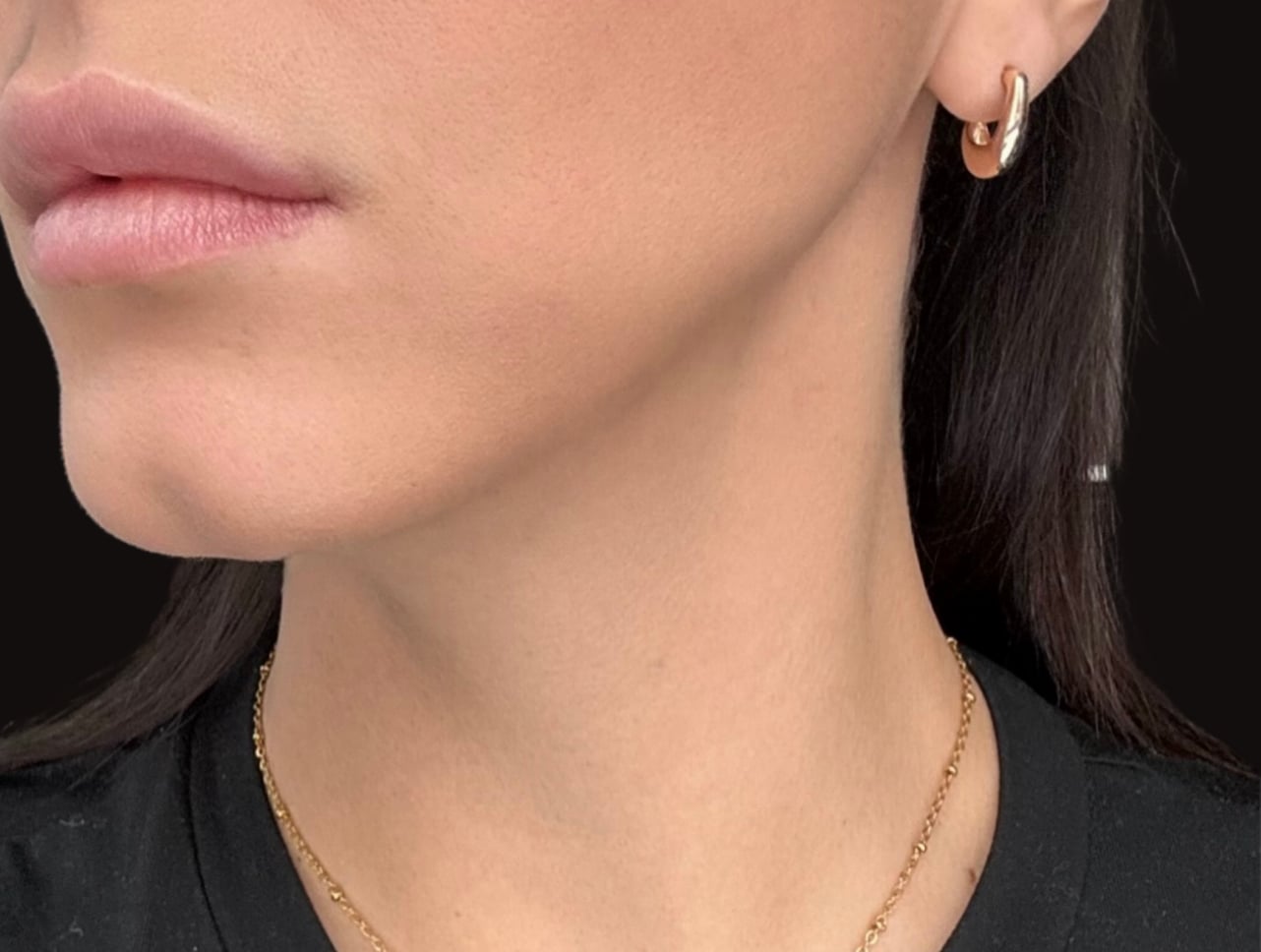 After Frosteam treatment showing smoother skin texture, reduced puffiness, and improved radiance along the jawline and neck area